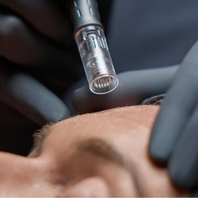 Facial con microneedling